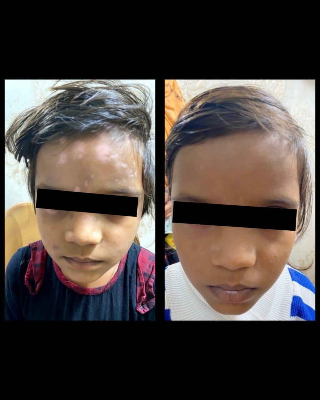 Chemical Peels clinic bilaspur